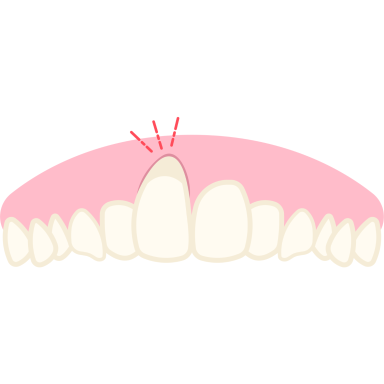 Récession gingivale