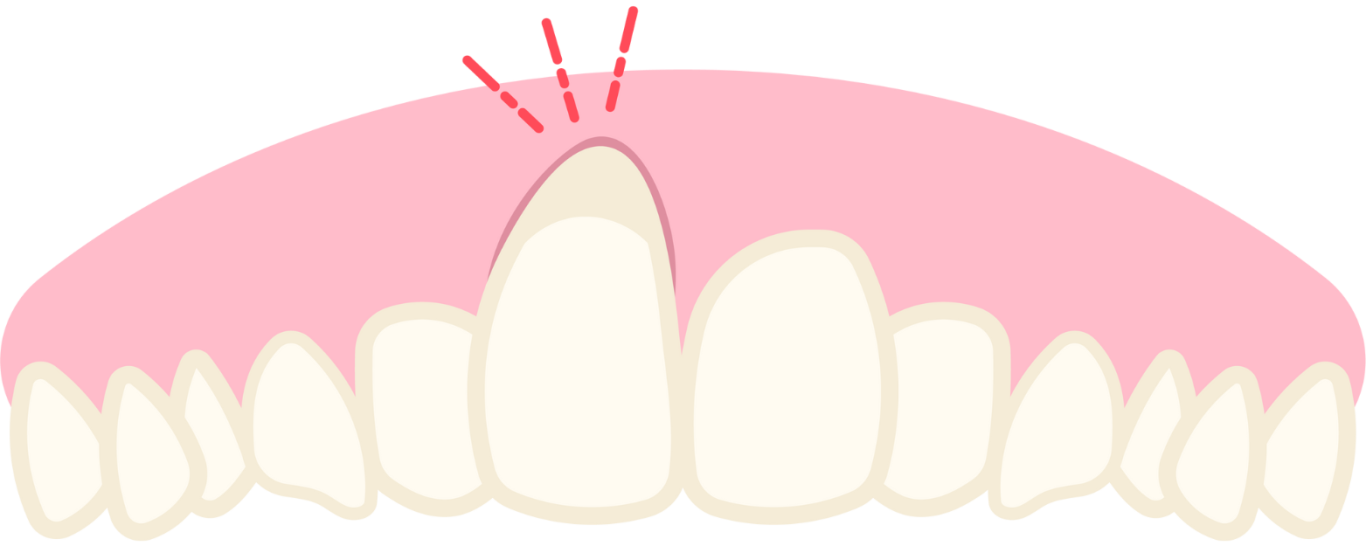 Récession gingivale