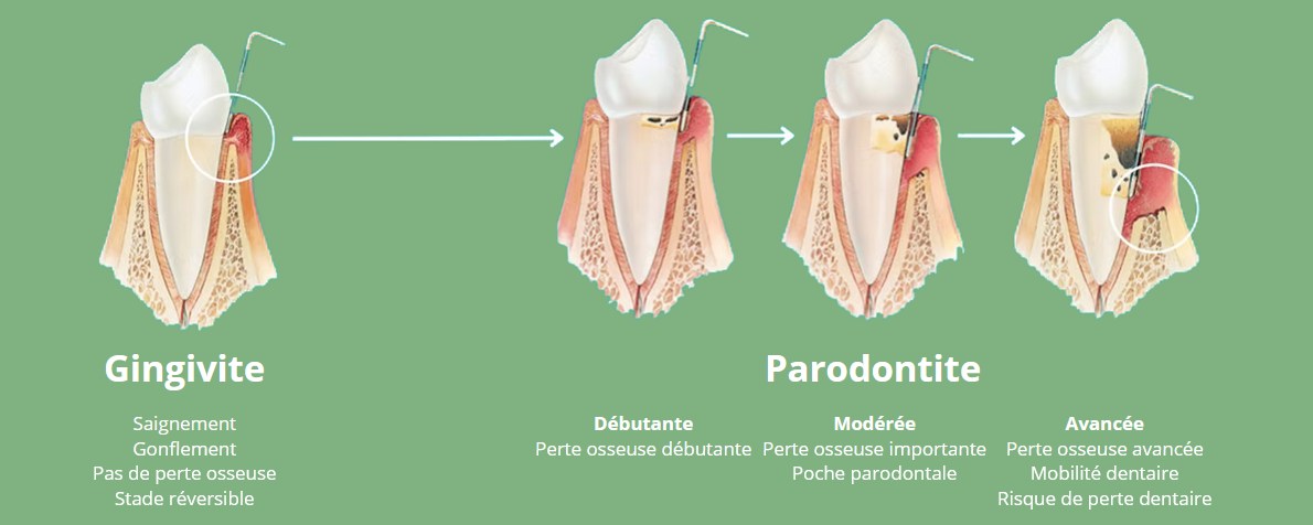 Schéma explicatif gingivite et parodontite