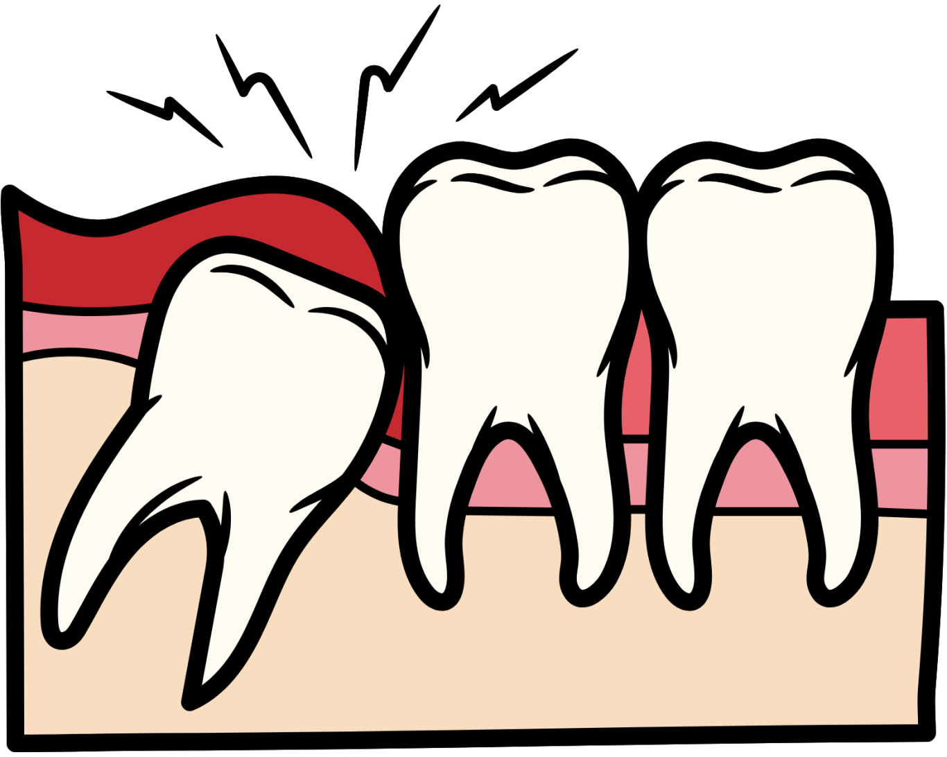 Schéma dents de sagesse