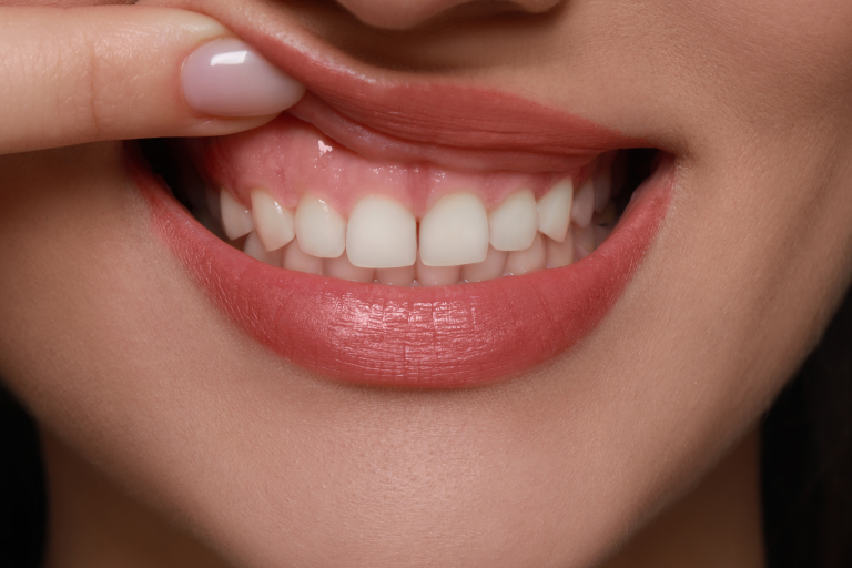Greffes gingivales